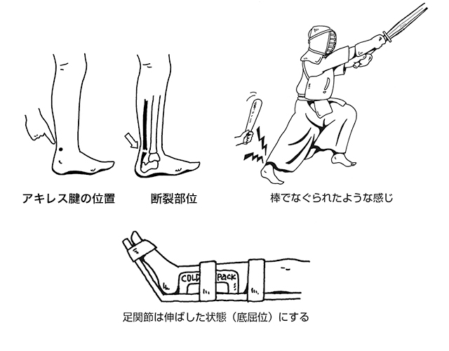 Rice処置 主なケガの応急処置 後編 全日本剣道連盟 Ajkf